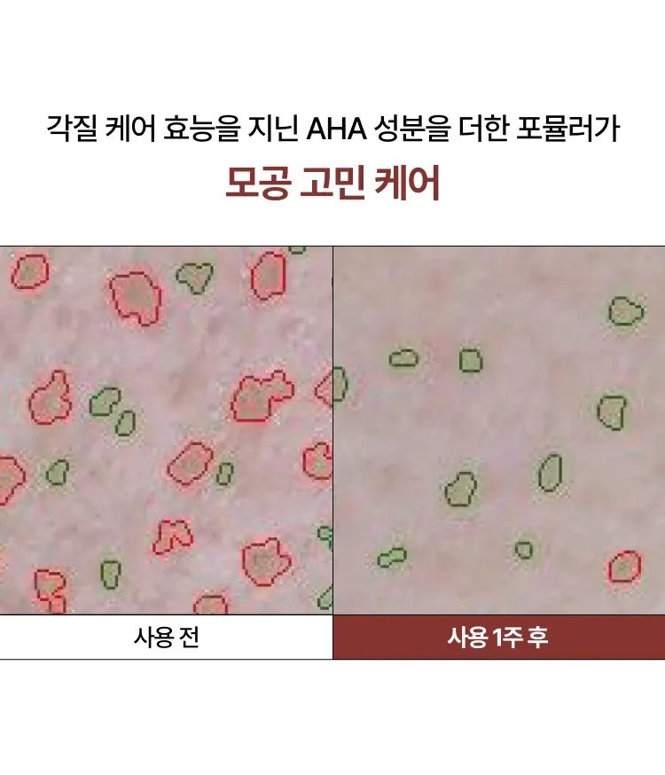 다양한 모공 고민을 한번에 해결해주며 각질 케어 효능을 지닌 AHA 성분이 함유된 피지흡착모공팩. 피부자극 테스트를 완료한 저자극 크리미 텍스처의 사용감. 모공 면적, 블랙헤드, 피부결, 각질 등 케어해주는 이니스프리 수퍼 화산송이 모공팩
